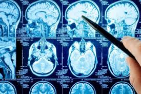 Безоплатні медичні послуги у випадку інсульту під час війни