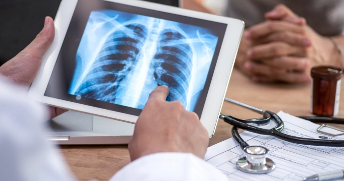 ФОКУС НА ТУБЕРКУЛЬОЗ